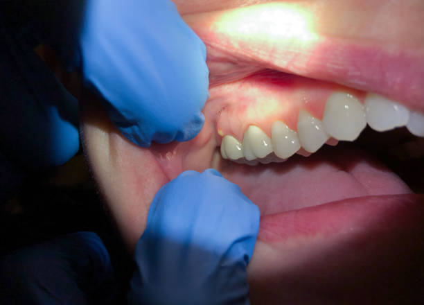 Best Emergency Root Canal Treatment in Pflugerville, TX