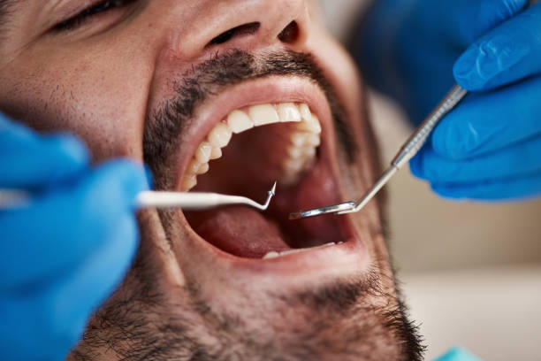 Best Emergency Wisdom Teeth Removal in Pflugerville, TX